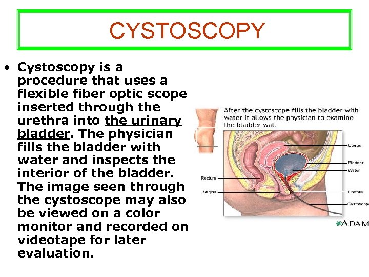 CYSTOSCOPY • Cystoscopy is a procedure that uses a flexible fiber optic scope inserted