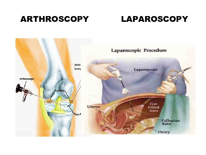 ARTHROSCOPY LAPAROSCOPY 