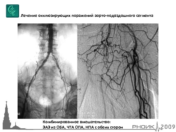 Лечение окклюзирующих поражений аорто-подвздошного сегмента Комбинированное вмешательство: ЭАЭ из ОБА, ЧТА ОПА, НПА с