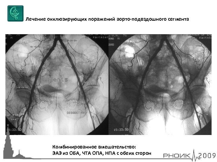 Лечение окклюзирующих поражений аорто-подвздошного сегмента Комбинированное вмешательство: ЭАЭ из ОБА, ЧТА ОПА, НПА с