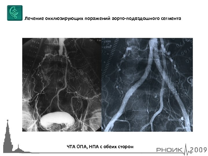 Лечение окклюзирующих поражений аорто-подвздошного сегмента ЧТА ОПА, НПА с обеих сторон 