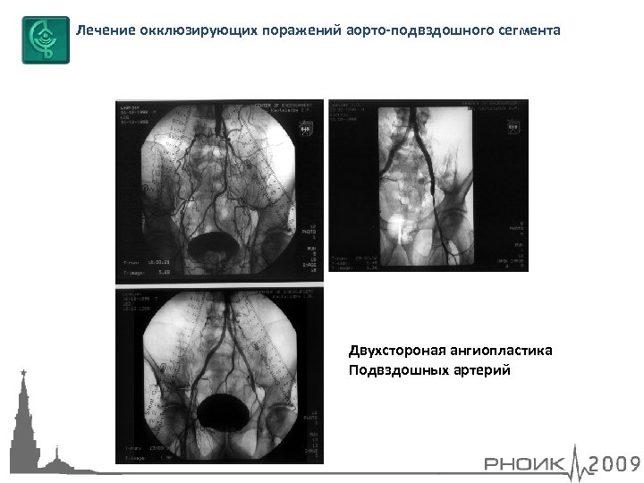 Лечение окклюзирующих поражений аорто-подвздошного сегмента Двухстороная ангиопластика Подвздошных артерий 