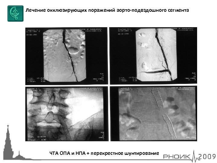 Лечение окклюзирующих поражений аорто-подвздошного сегмента ЧТА ОПА и НПА + перекрестное шунтирование 