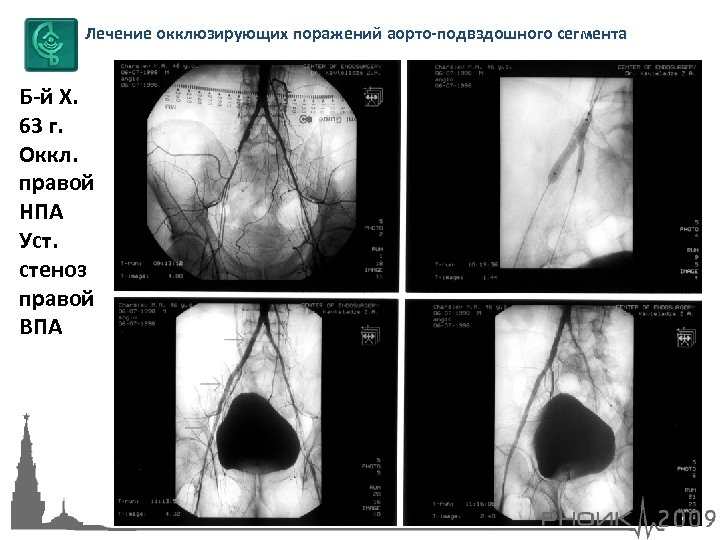 Лечение окклюзирующих поражений аорто-подвздошного сегмента Б-й Х. 63 г. Оккл. правой НПА Уст. стеноз