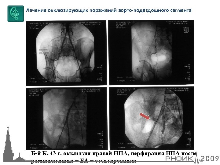 Лечение окклюзирующих поражений аорто-подвздошного сегмента Б-й К. 43 г. окклюзия правой НПА, перфорация НПА