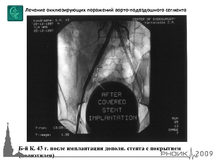 Лечение окклюзирующих поражений аорто-подвздошного сегмента Б-й К. 43 г. после имплантации дополн. стента с