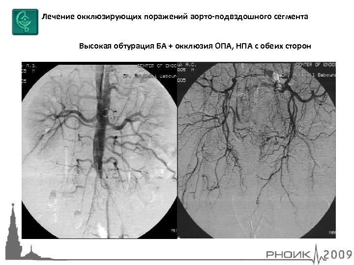 Лечение окклюзирующих поражений аорто-подвздошного сегмента Высокая обтурация БА + окклюзия ОПА, НПА с обеих