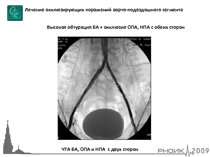 Лечение окклюзирующих поражений аорто-подвздошного сегмента Высокая обтурация БА + окклюзия ОПА, НПА с обеих