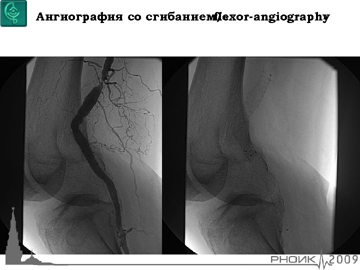 Ангиография со сгибанием/ « flexor-angiography » 