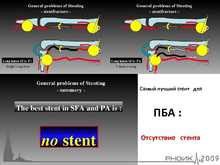 Самый лучший стент для ПБА : Отсутствие стента 