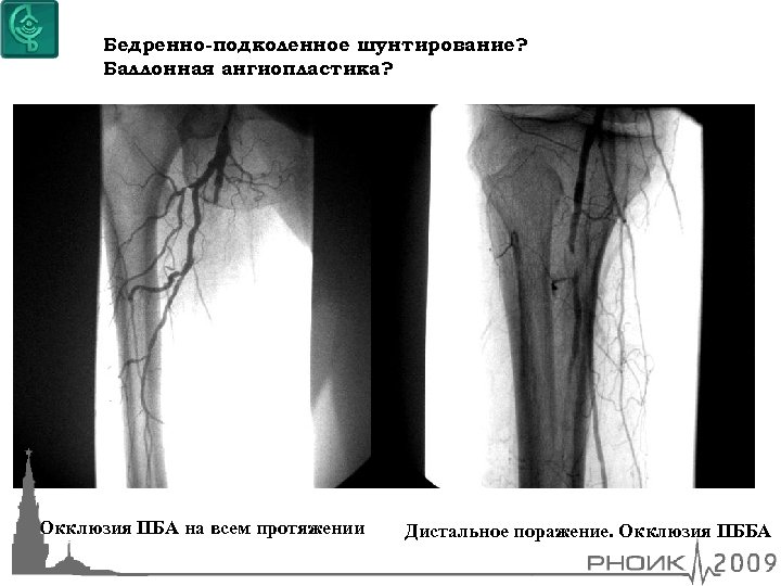 Бедренно-подколенное шунтирование? Баллонная ангиопластика? Окклюзия ПБА на всем протяжении Дистальное поражение. Окклюзия ПББА 