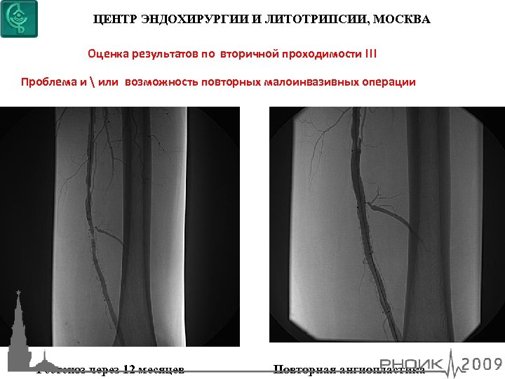 ЦЕНТР ЭНДОХИРУРГИИ И ЛИТОТРИПСИИ, МОСКВА Оценка результатов по вторичной проходимости !!! Проблема и 