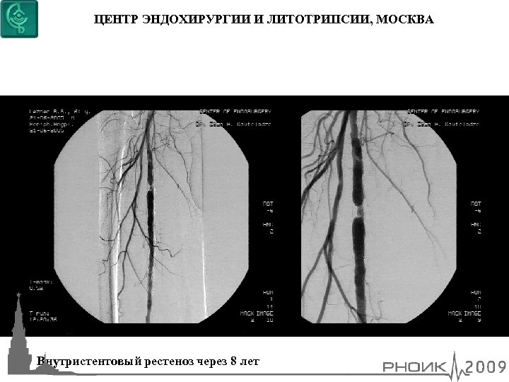 ЦЕНТР ЭНДОХИРУРГИИ И ЛИТОТРИПСИИ, МОСКВА Внутристентовый рестеноз через 8 лет 