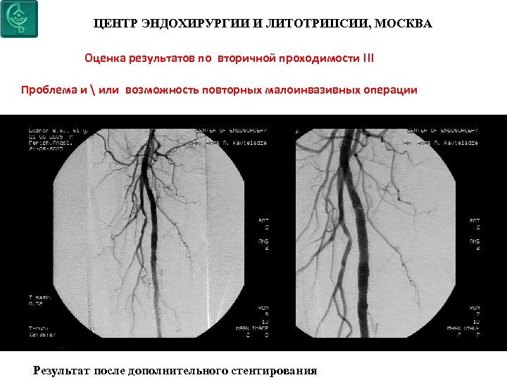ЦЕНТР ЭНДОХИРУРГИИ И ЛИТОТРИПСИИ, МОСКВА Оценка результатов по вторичной проходимости !!! Проблема и 