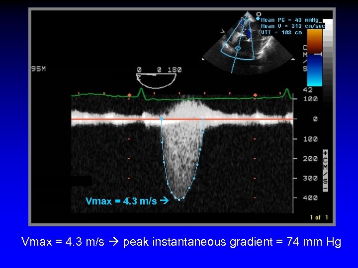 Vmax = 4. 3 m/s peak instantaneous gradient = 74 mm Hg 