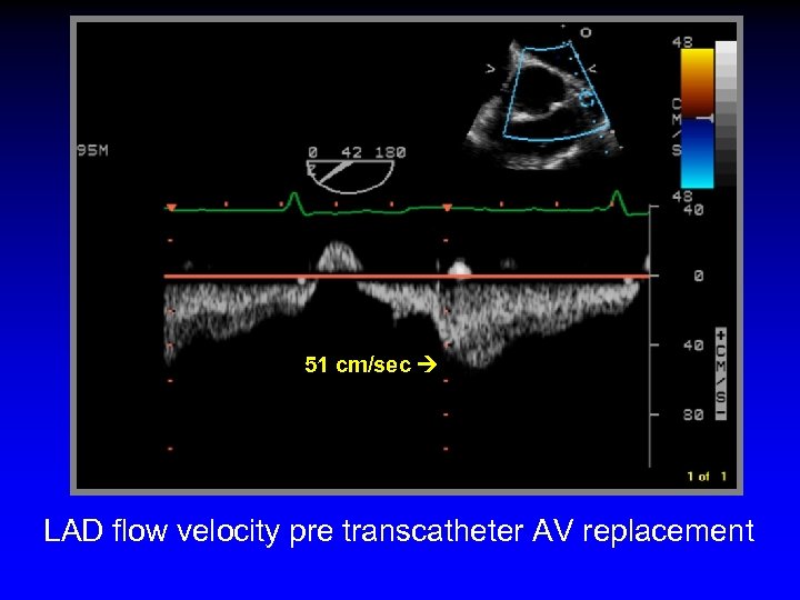 51 cm/sec LAD flow velocity pre transcatheter AV replacement 