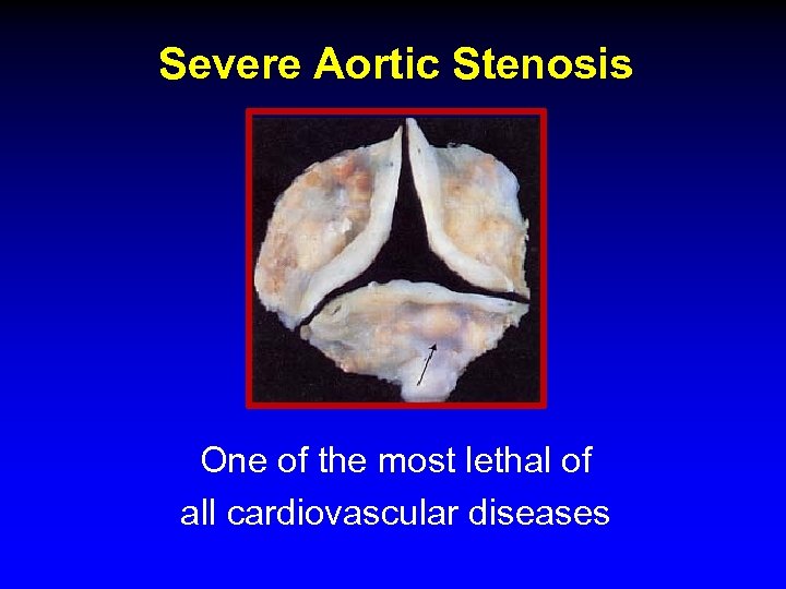 Severe Aortic Stenosis One of the most lethal of all cardiovascular diseases 