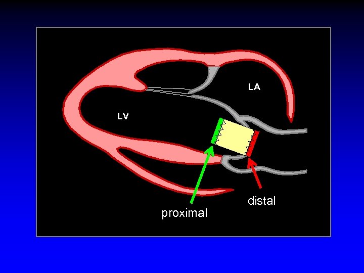 LA LV proximal distal 