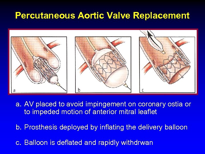 Percutaneous Aortic Valve Replacement a. AV placed to avoid impingement on coronary ostia or