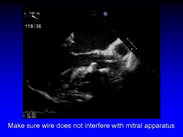 Make sure wire does not interfere with mitral apparatus 