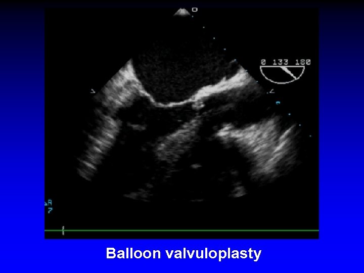 Balloon valvuloplasty 