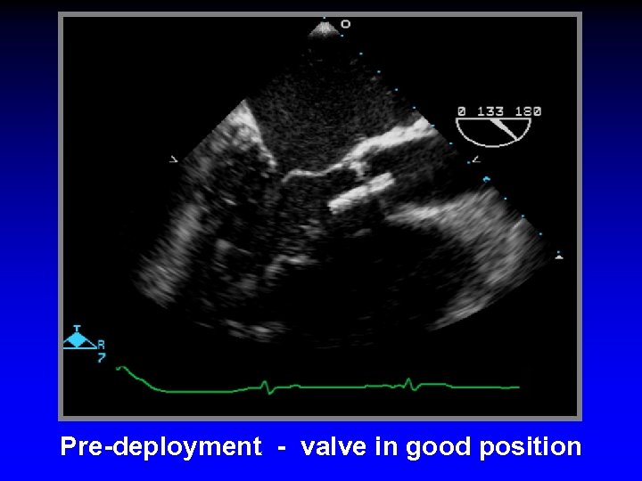 Pre-deployment - valve in good position 