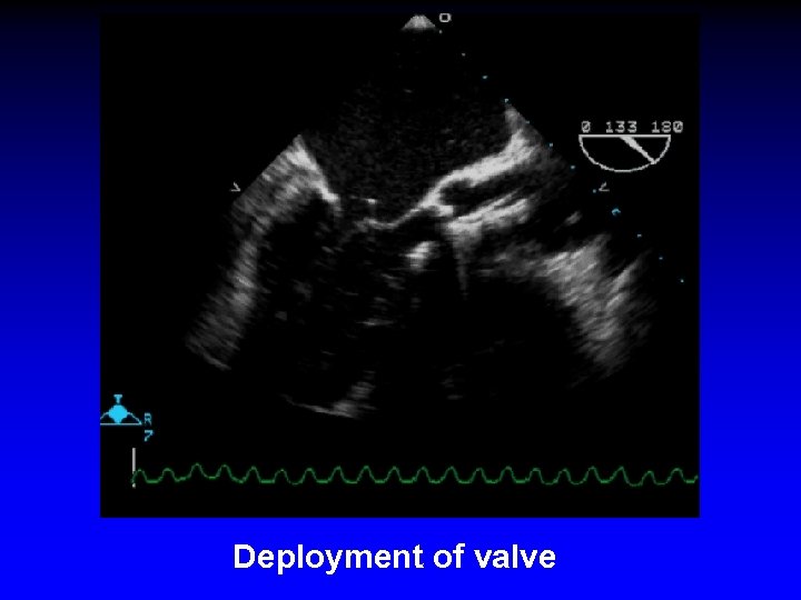 Deployment of valve 