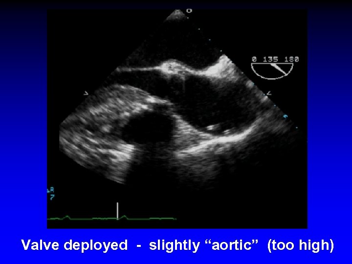 Valve deployed - slightly “aortic” (too high) 