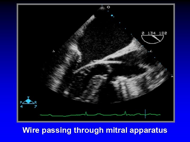 Wire passing through mitral apparatus 