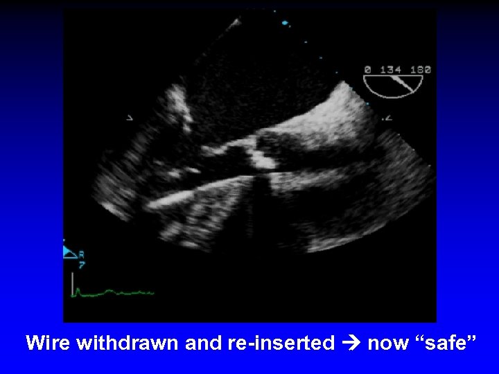Wire withdrawn and re-inserted now “safe” 