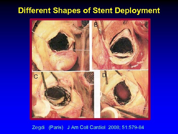 Different Shapes of Stent Deployment Zegdi (Paris) J Am Coll Cardiol 2008; 51: 579