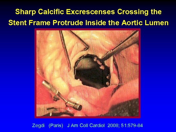 Sharp Calcific Excrescenses Crossing the Stent Frame Protrude Inside the Aortic Lumen Zegdi (Paris)