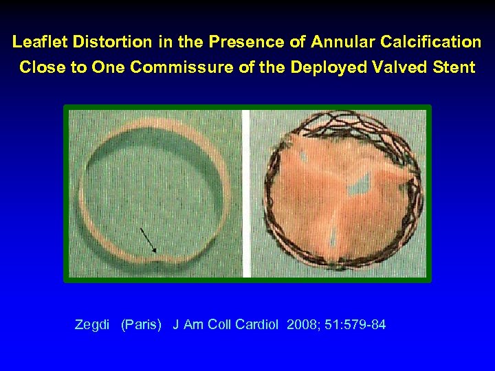 Leaflet Distortion in the Presence of Annular Calcification Close to One Commissure of the