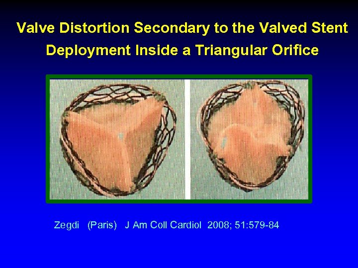 Valve Distortion Secondary to the Valved Stent Deployment Inside a Triangular Orifice Zegdi (Paris)