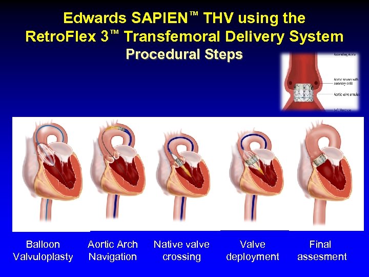 Edwards SAPIEN™ THV using the Retro. Flex 3™ Transfemoral Delivery System Procedural Steps Balloon