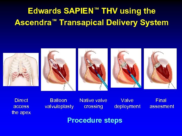 Edwards SAPIEN™ THV using the Ascendra™ Transapical Delivery System Direct access the apex Balloon