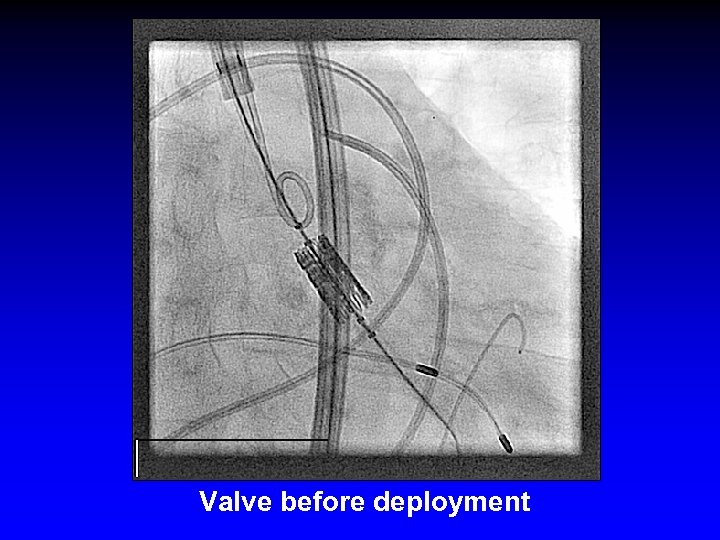 Valve before deployment 