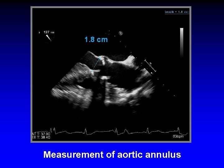 1. 8 cm Measurement of aortic annulus 