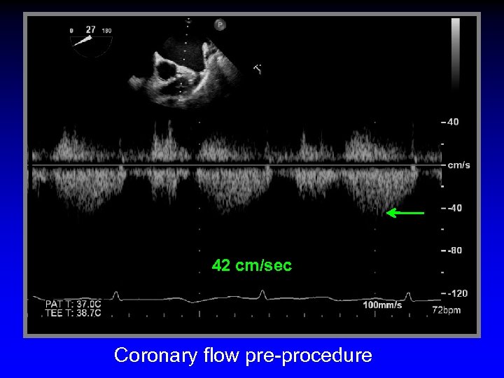 42 cm/sec Coronary flow pre-procedure 