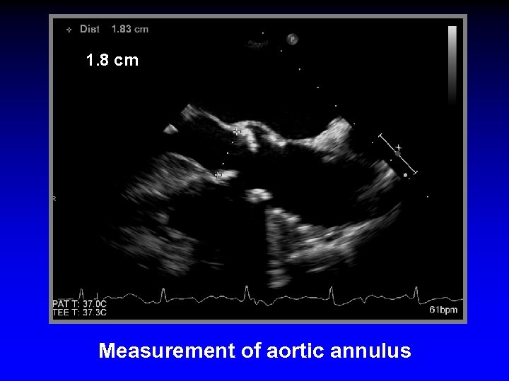 1. 8 cm Measurement of aortic annulus 