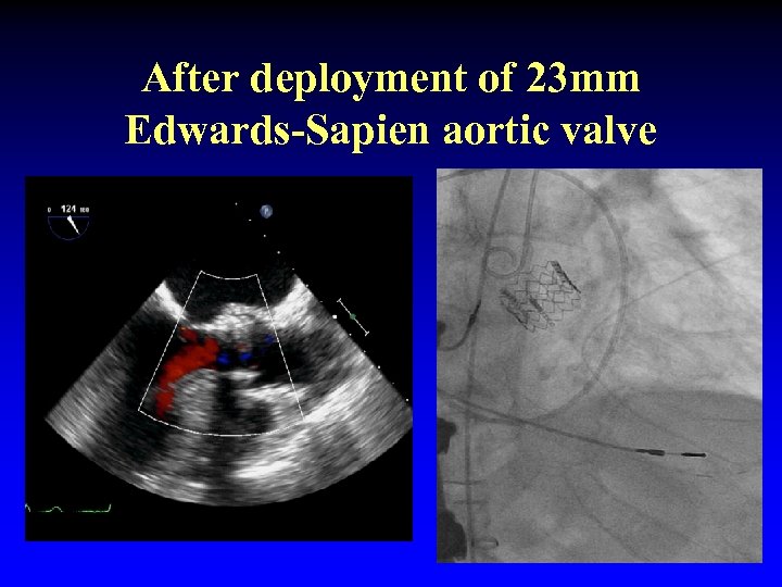 After deployment of 23 mm Edwards-Sapien aortic valve 