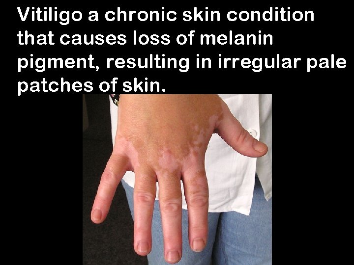 Vitiligo a chronic skin condition that causes loss of melanin pigment, resulting in irregular