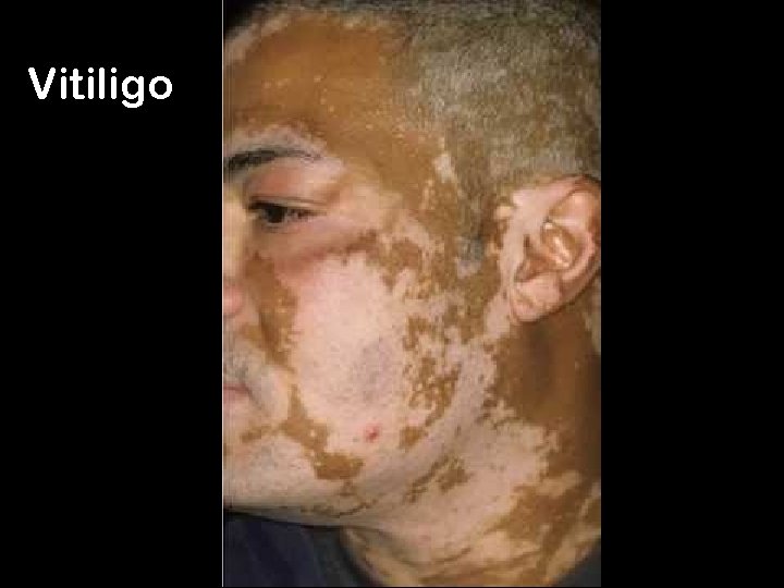 Vitiligo 20 