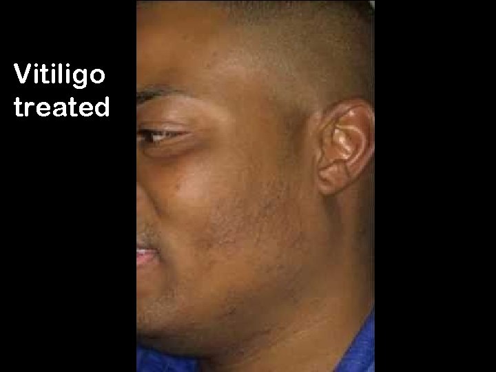Vitiligo treated 21 