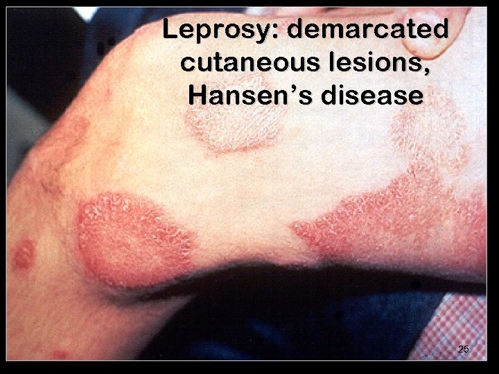 Leprosy: demarcated cutaneous lesions, Hansen’s disease 25 
