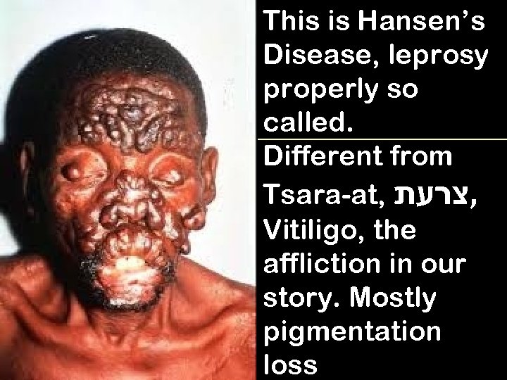 This is Hansen’s Disease, leprosy properly so called. Different from Tsara-at, , צרעת Vitiligo,