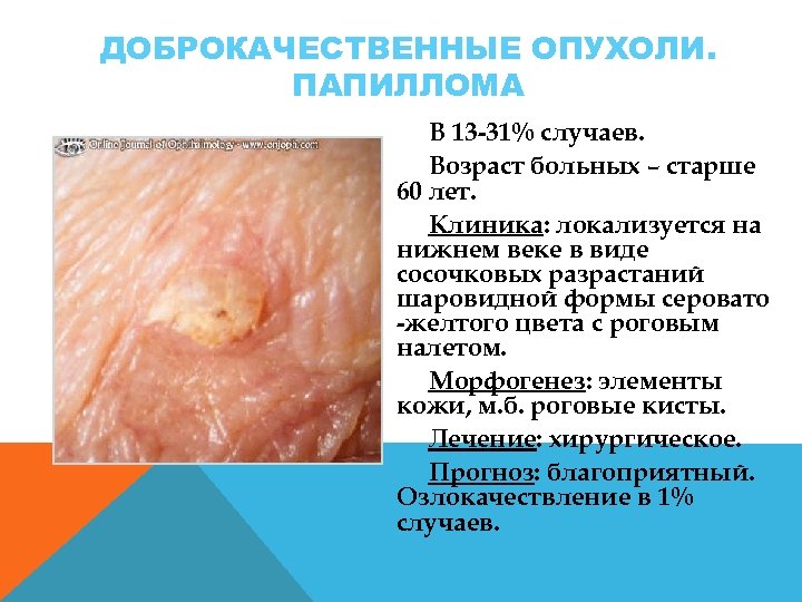 ДОБРОКАЧЕСТВЕННЫЕ ОПУХОЛИ. ПАПИЛЛОМА В 13 -31% случаев. Возраст больных – старше 60 лет. Клиника: