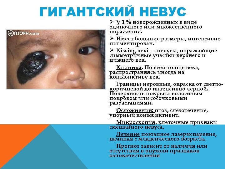 ГИГАНТСКИЙ НЕВУС Ø У 1 % новорожденных в виде одиночного или множественного поражения. Ø