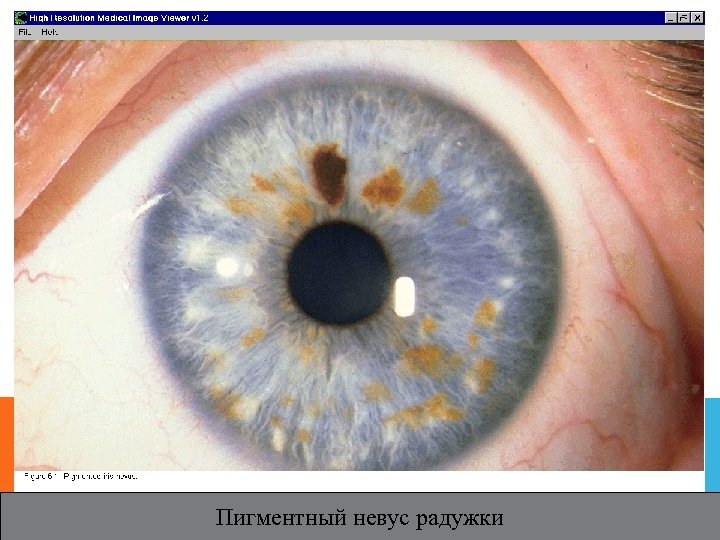 Пигментный невус радужки 