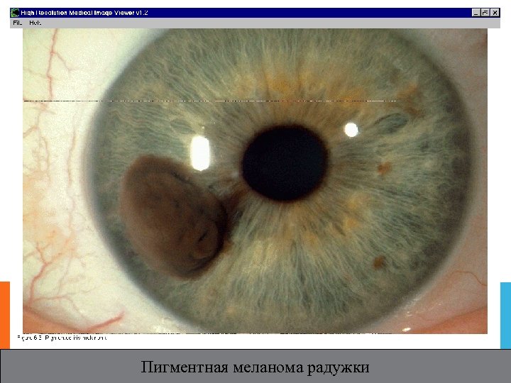 Пигментная меланома радужки 